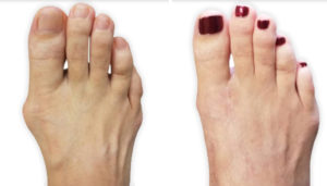 Bunion Care with Panorama Orthopedic and Spine Center