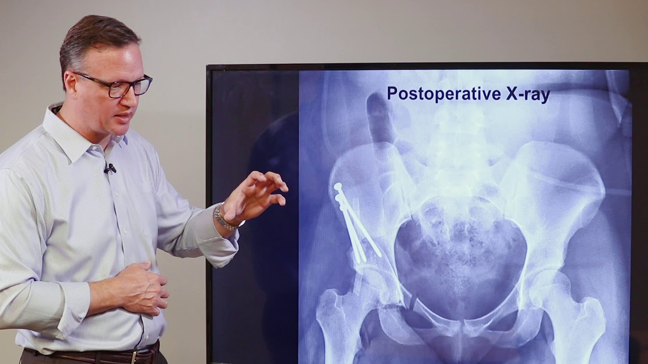 Hip Preservation 4 Dr. Ronald hugate, md explaining what to expect from ganz osteotomy surgery while showing a postoperative x-ray.