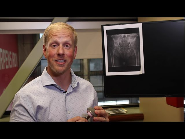 Joint Replacement 4 What you need to know about hip replacement