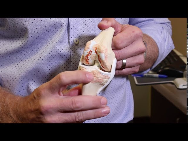 Joint Replacement 5 What you need to know about a knee replacement