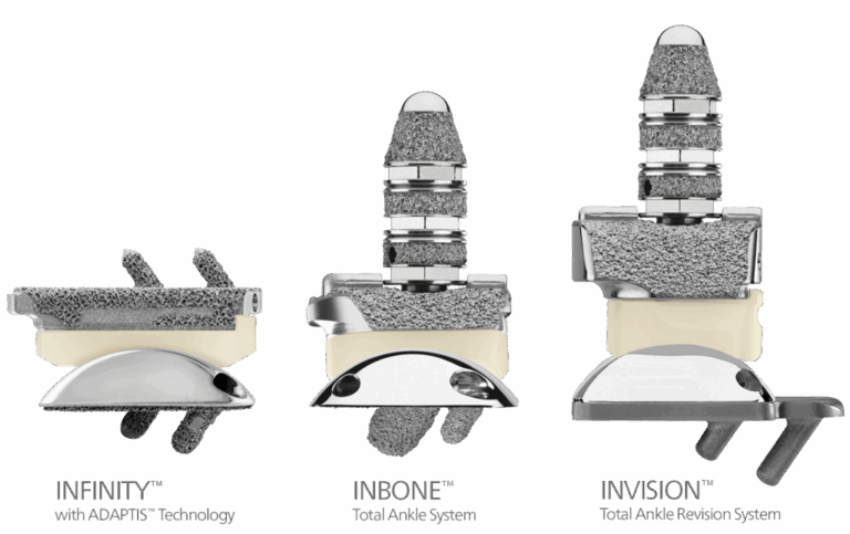 Examples of total ankle implants 1 1024x644 1